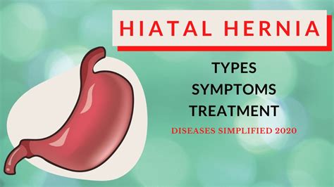 Hiatal Hernia: Types, Symptoms & Treatment - YouTube