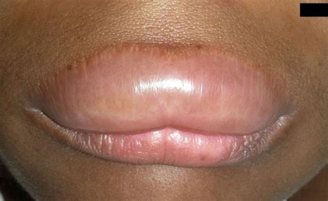 Angioedema: Symptoms, Causes, Risk Factors, Treatment and Prevention - Scope Heal