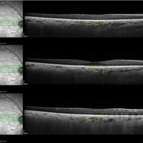 Choroidal Thickness Measure | Download Scientific Diagram