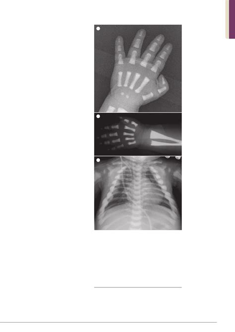 Osteopetrosis: Genetics, treatment and new insights into osteoclast ...