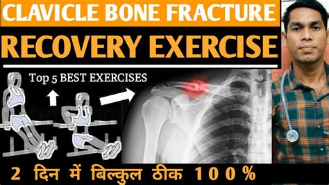 Clavicle exercise after surgery, broken, fracture, mobility, injury, collarbone exercises for ...