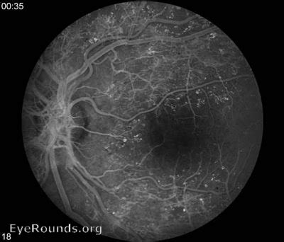 Proliferative diabetic retinopathy . EyeRounds.org: Online Ophthalmic Atlas