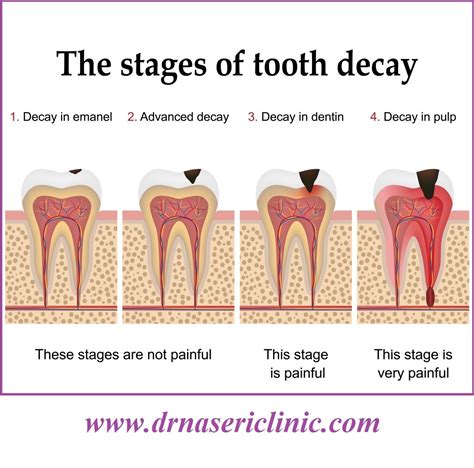 health risks of tooth decay - dr. naseri clinic - risks of tooth decay