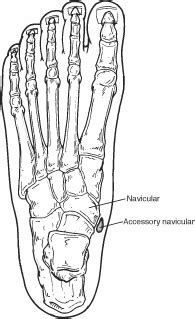 Accessory Navicular – California Foot and Ankle Institute