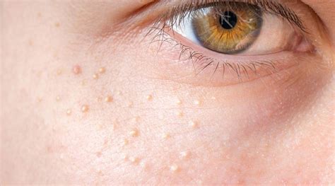 Ultimate Acne Guide: Types of Acne, Causes of Acne & Acne Treatments