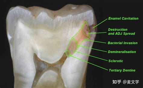 如何让蛀牙停止恶化? - 知乎