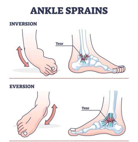 Medial Ankle Sprain