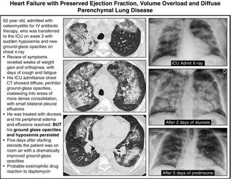 Diffuse parenchymal lung disease and its mimics | Thoracic Key