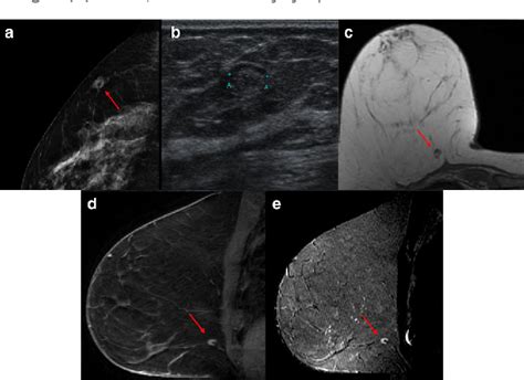 Intramammary lymph nodes: Normal and abnormal multimodality imaging features. | Semantic Scholar