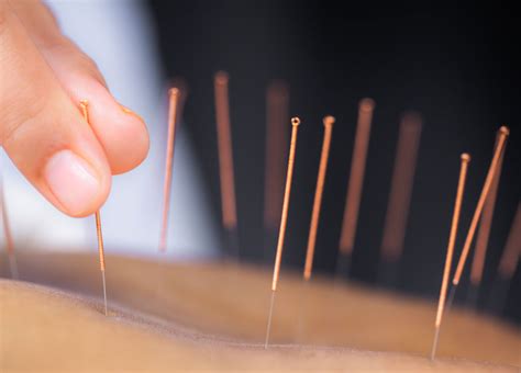 Acupuncture Promotes Healthy Weight Reduction