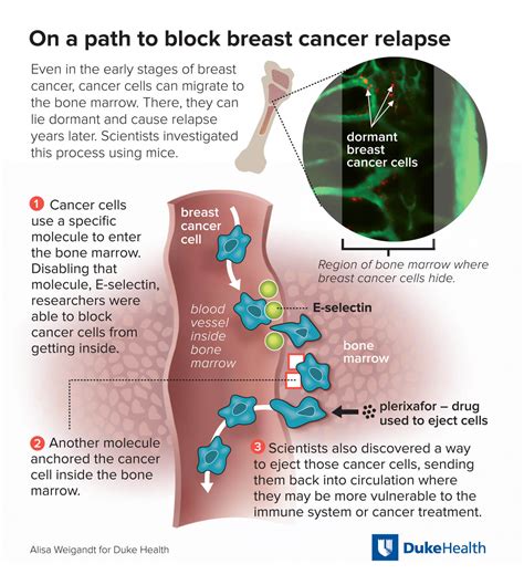 Cancer’s Spread to Bone - National Cancer Institute