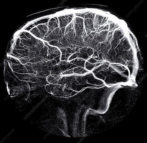 Venous Phase Cerebral Angiogram - Stock Image - C030/6478 - Science ...