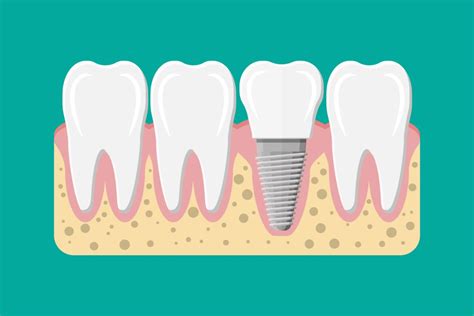 The Risks of Dental Implants | Parkcrest Dental Group