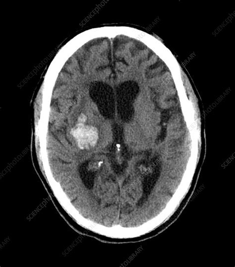 Brain haemorrhage, MRI scan - Stock Image - C007/5256 - Science Photo ...