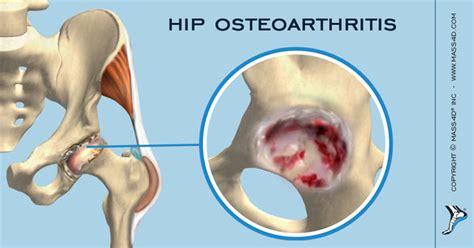 Understanding Hip Osteoarthritis - MASS4D® Foot Orthotics