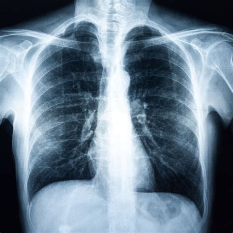 Bronchitis Lungs Xray