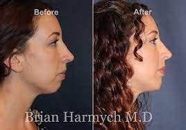 How long does chin implant recovery take? - Cosmetic Surgery Tips