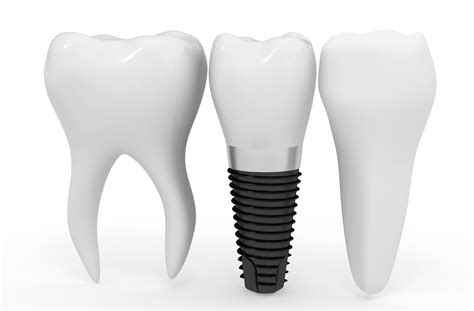 Dental Implants 101 - Downtown Dental Nashville