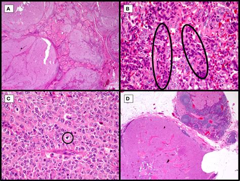 Frontiers | Genetics, Diagnosis, and Management of Hürthle Cell Thyroid ...