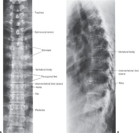 Thoracic Spine X Ray Lateral - cloudshareinfo