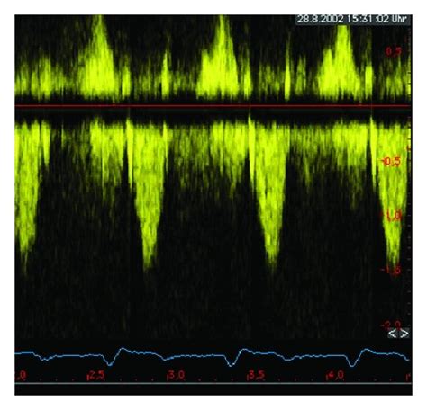 Echocardiographic aspect of HOCM before/after a myectomy ((a)–(d)) and ...