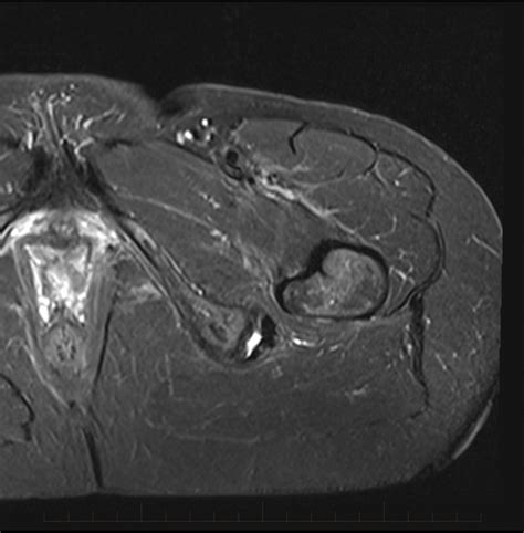 mri-hamstring-bursitis-1 - MRI at Melbourne Radiology Clinic