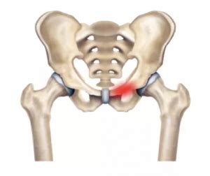 Osteitis Pubis - City Hospital, Dehradun