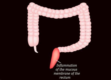 Proctitis : Overview, causes, types, symptoms, & treatment | FactDr