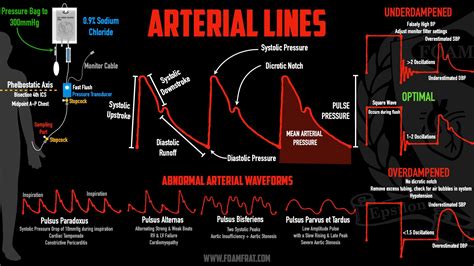 Arterial Lines For Nurses