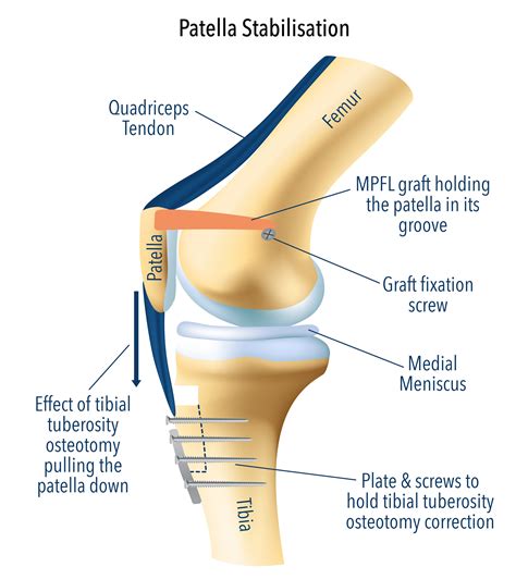 Patella Stabilization Surgery | MPFL Reconstruction Surgery