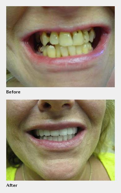 Lumineers Versus Porcelain Veneers | O'Fallon, IL