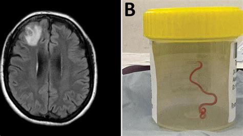 Live worm found in Australian woman's brain in world first | The Ghana Report