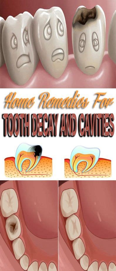 Home Remedies for Tooth Decay and Cavities.. | Tooth decay, Oral care, Natural oral care