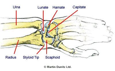 Broken Wrist - Capitate Fracture | PhysioRoom Injury Advice