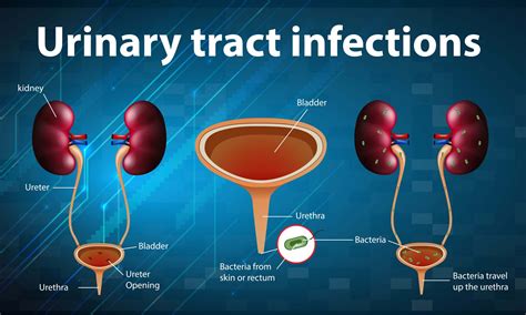 5 Home Remedies for Urinary Tract Infection - Allcare Health NJ