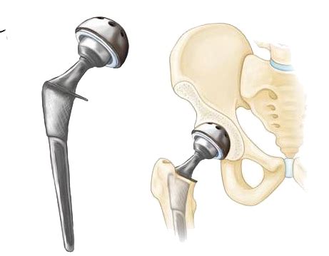 DePuy Synthes Orthopedics Hip Replacement Technology Profile