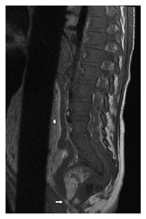 Spine MRI on day 5 to further characterize the presacral mass. (a)... | Download Scientific Diagram