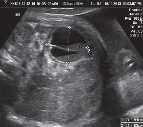 Biloculated cyst with septa and adjacent two cysts. | Download ...