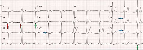 delta wave ecg