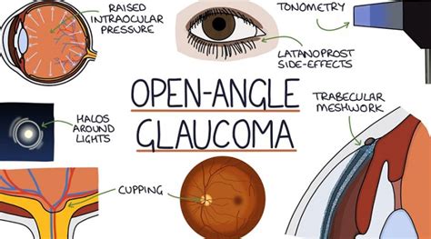 Advancements in Treatment of Open-Angle Glaucoma | OBN