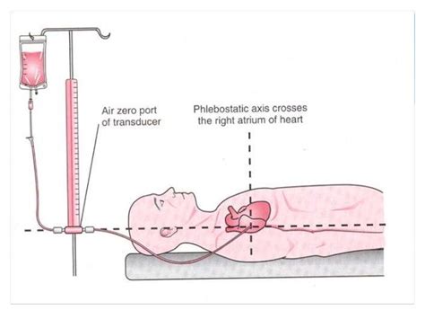 Central Venous Pressure Wave