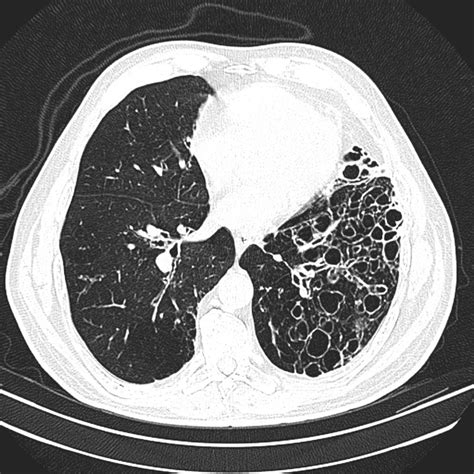 cystic-bronchiectasis-3 – PinkyBone