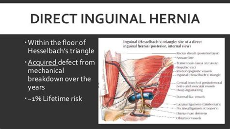 Triangle Direct Inguinal Hernia | Images and Photos finder