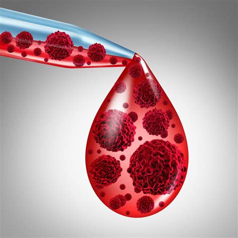 Polycythemia Vera : Overview, Causes, Symptoms, Treatment - illness.com