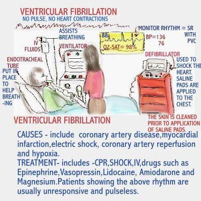 V Fib Treatment - theme-arabic