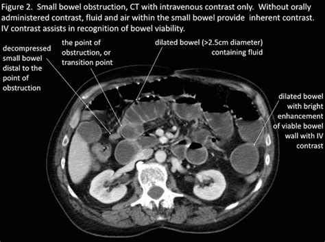 What are the signs of small bowel obstruction? - paperwingrvice.web.fc2.com