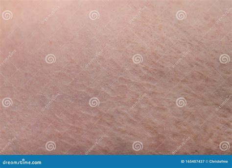 Texture of Human`s Skin with the Scar Burn, Closeup Photo Stock Image - Image of background ...