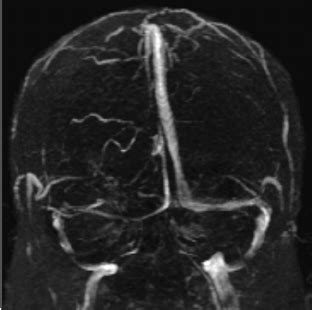 Transverse Sinus Mri