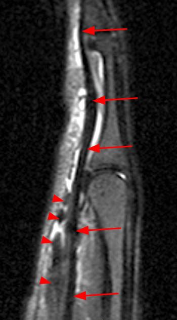 Flexor Tendon Injuries | Radsource