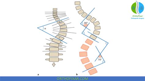 Cobb Angle For Scoliosis | OrthoFixar 2024